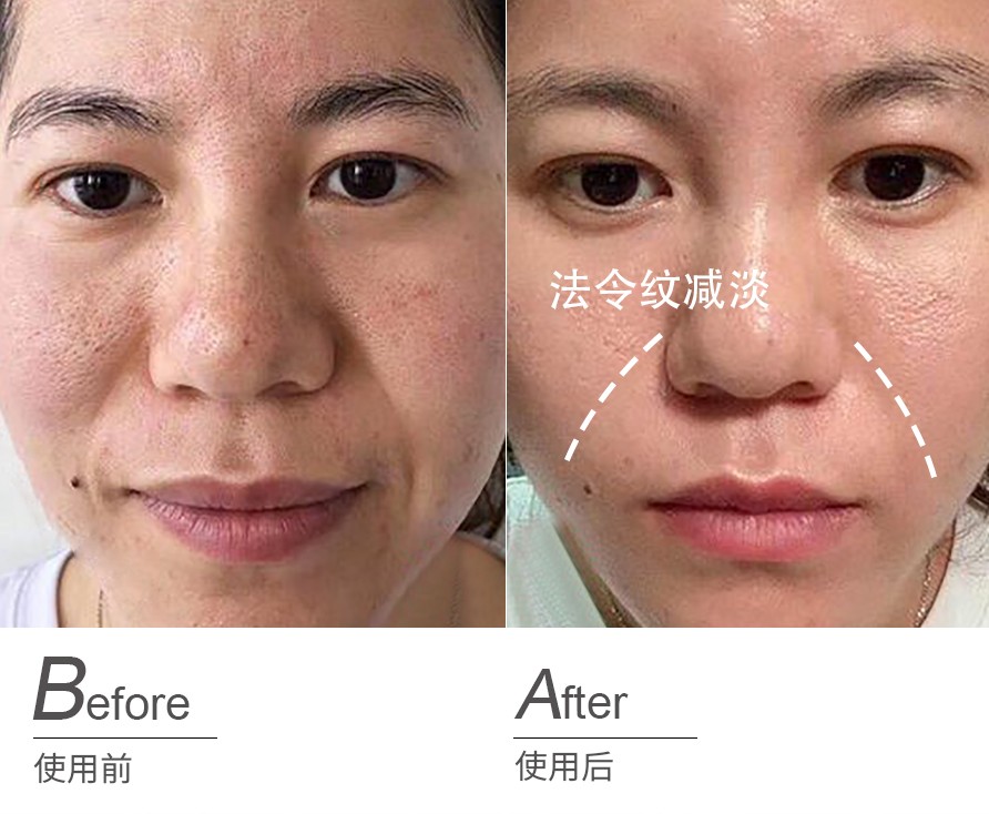 美容儀